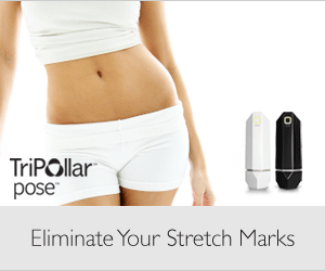 TriPollar POSE treatment for stretch marks