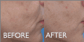 TriPollar STOP - Before and After